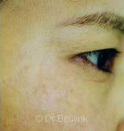 laser pigmentation after (180)